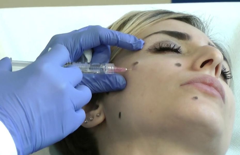 Profhilo Injections